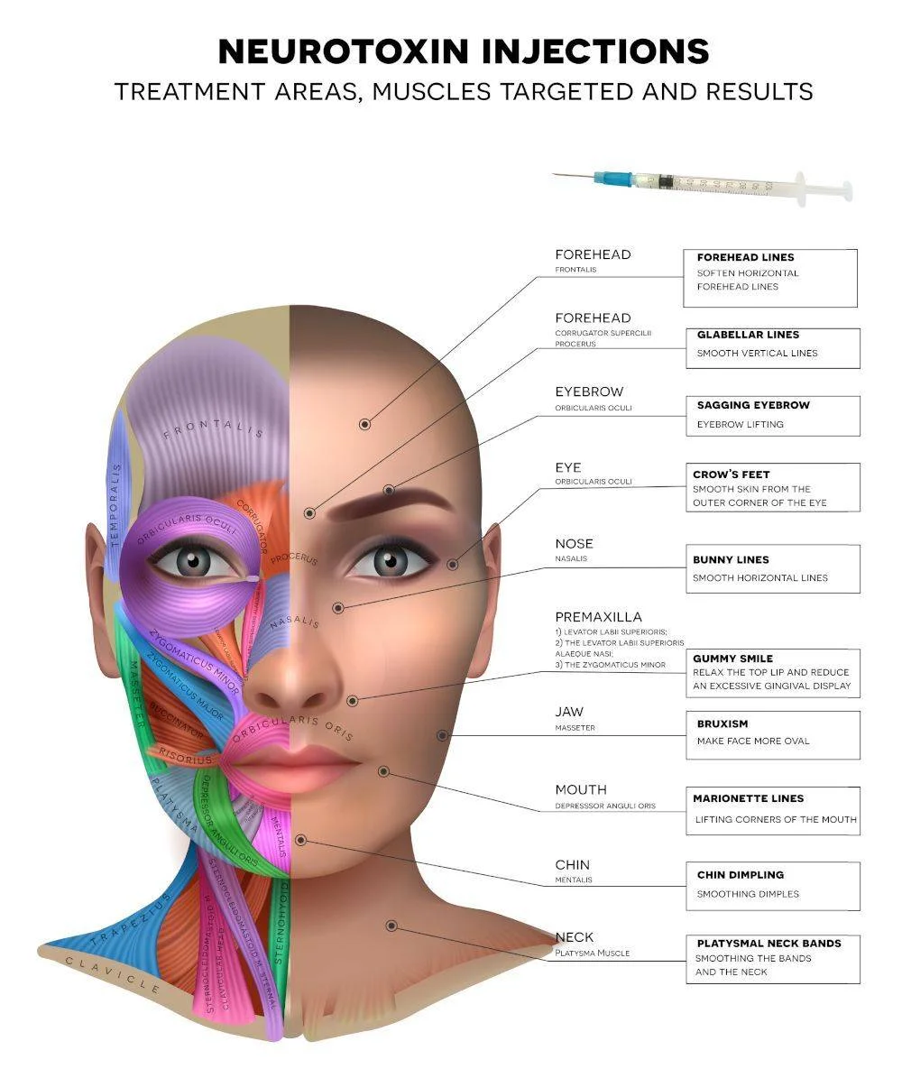 neurotoxin injections R & R aesthetics roswell GA