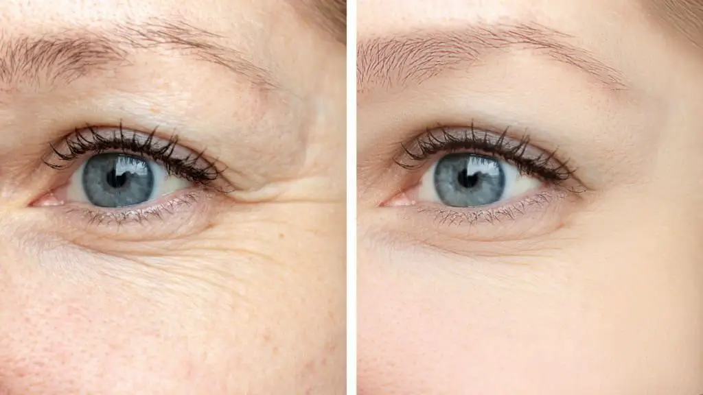 How Anti-Wrinkle Injectables Can Help Reduce Fine Lines roswell ga