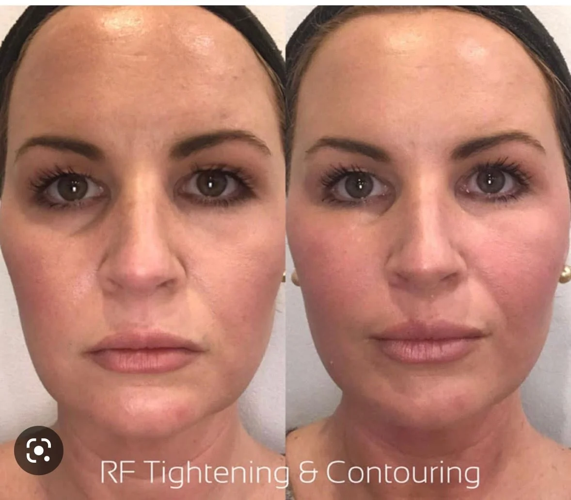 Microneedling Treatment