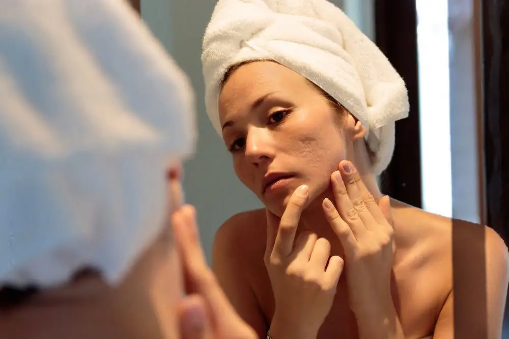 TARGETING ACNE SCARS HOW PRP MICRONEEDLING FACIAL CAN HELP IMPROVE SKIN TEXTURE