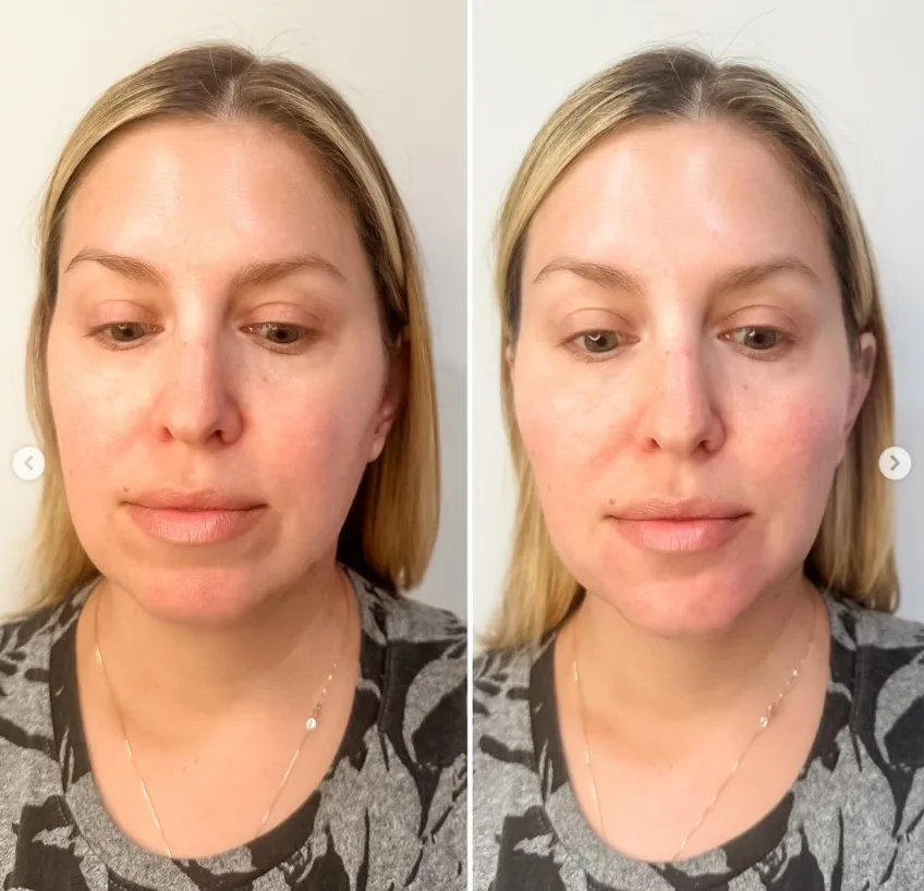 Full Face Rejuvenation with filler: Before and After of a woman's transformation at R & R Aesthetics, Roswell, Georgia.