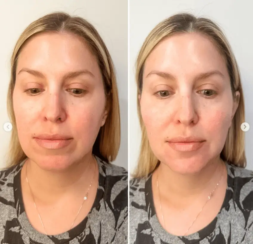 Full Face Rejuvenation with filler: Before and After of a woman's transformation at R & R Aesthetics, Roswell, Georgia.