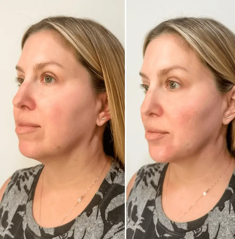 Full Face Rejuvenation with filler: Before and After of a woman's transformation at R & R Aesthetics, Roswell, Georgia.