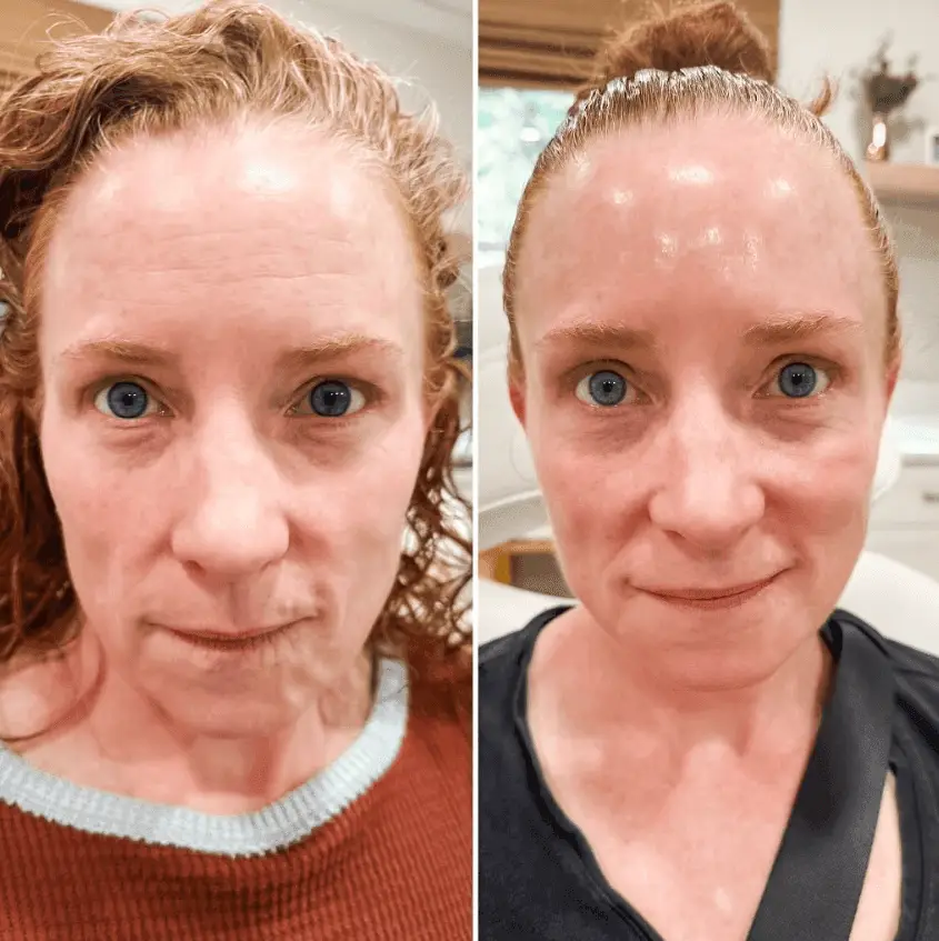 botox treatment image before after R & R Aesthetics Roswell GA