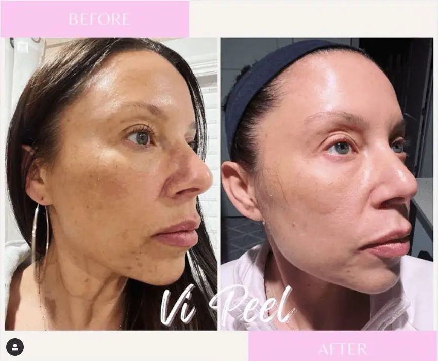 vi peel treatment image r&R aesthetics roswell GA