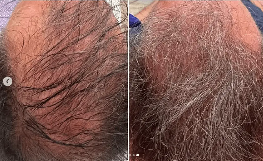 Give the gift of Hair Restoration-with Exosomes
