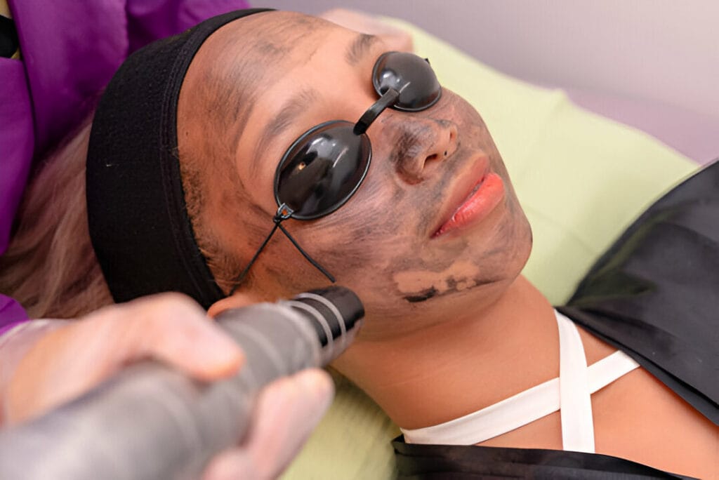 Pico-Laser-for-Melasma-FDA-Approved-Treatment-Now-Available-in-Roswell-GA