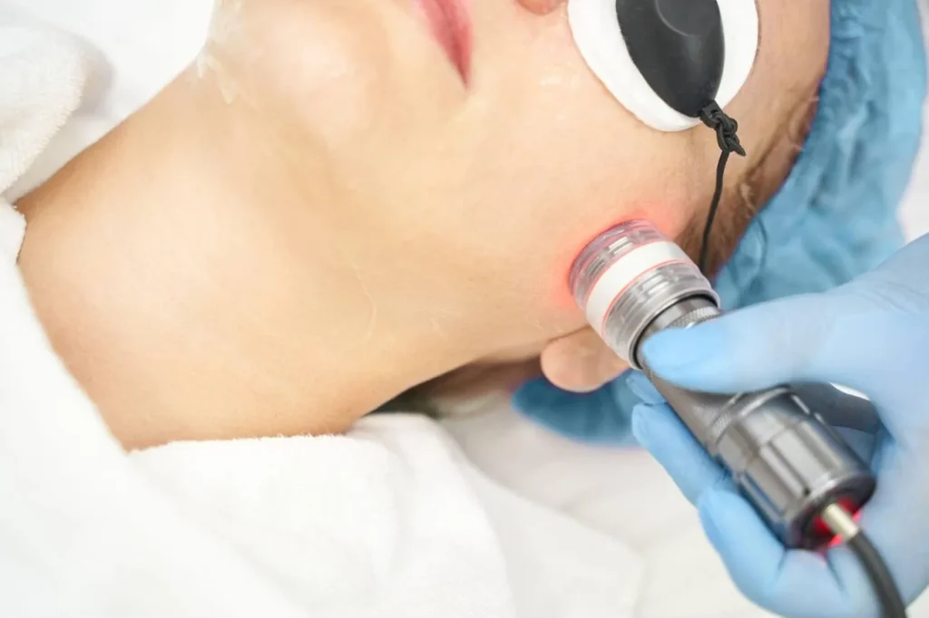 How-Pico-Laser-Combines-with-PRP-VI-Peel-or-Microneedling-for-Ultimate-Skin-Transformation
