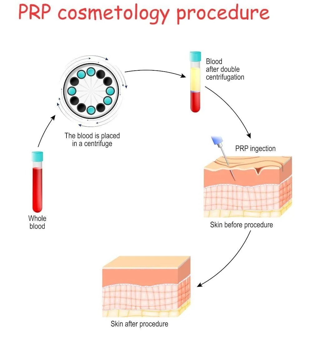 PRP-Cosmetology-Procedure-Hero-Radiant-and-Renewed-Aesthetics-Roswell-Georgia