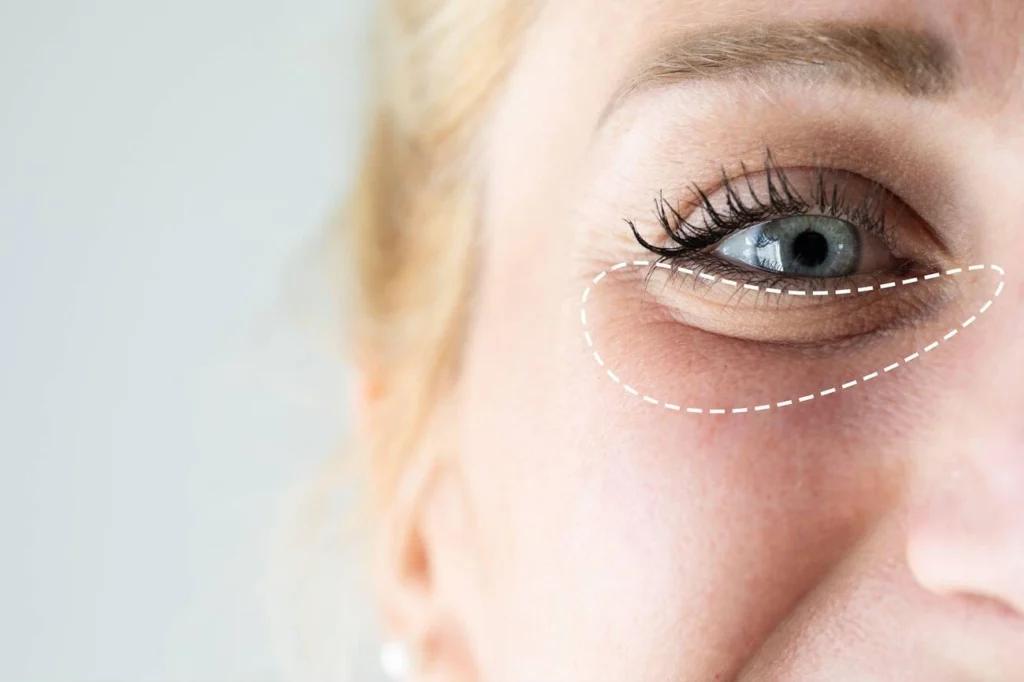 Under-Eye-Rejuvenation-Filler-vs-PRP-Which-Is-Better